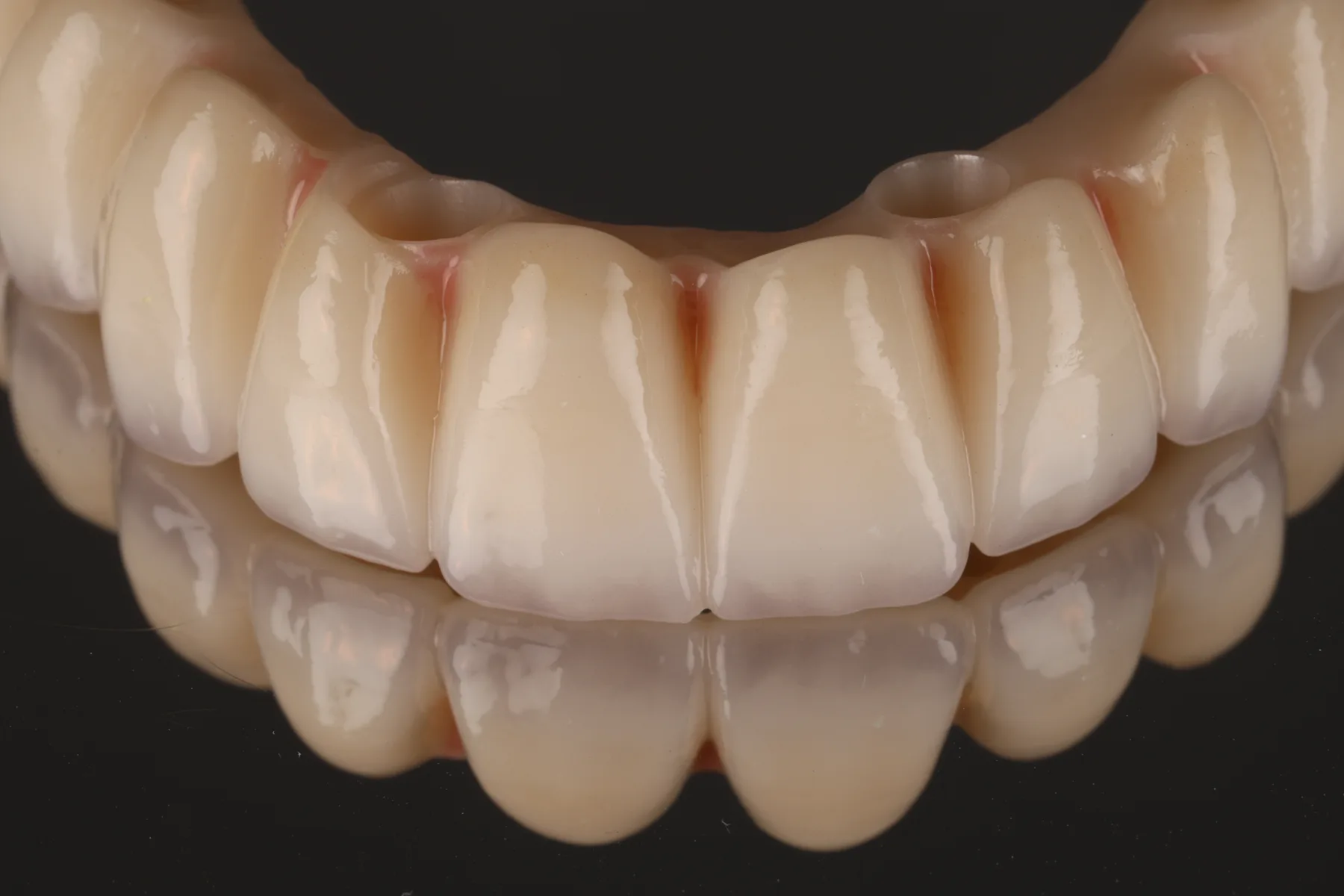 Een volledige zirkonium implantaatbrug uit ons eigen lab